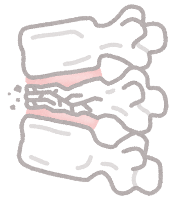 動きケアⓇで脊椎圧迫骨折後のQOL改善（１）